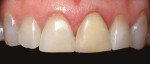 Tooth immediately after re-restoration with resin composite.