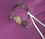 Figure 6  Isolation of tooth No. 20, Case 1.