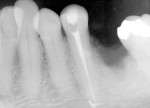 Figure 8  Postoperative radiograph showing the filled tooth, Case 1.