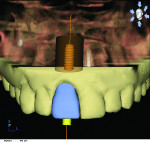 Figure 12 Incorporation of an ideal fixed temporary provisional into a digital implant proposal (reverse engineering concept via CEREC, Sirona Dental, Inc.).