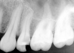 Figure 9  Preoperative radiograph of tooth No. 13, Case 2.