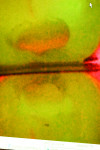 Figure 2 A caries detection camera (Spectra, Air Techniques Inc., www.airtechniques.com) was used to detect decay that was still present, which is noted by the red hue on green image.