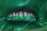 Figure 6 A dental dam was placed. Veneers were then ready for placement. Composite BL was applied and smoothed, covering the back of the veneer with a spatula. Flash was removed and the veneers were placed and tacked for temporary placement.