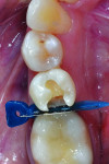 Figure 2 After successful anesthesia using 4% Articadent® with epinephrine 1:200,000 (DENTSPLY Pharmaceutical), a Palodent® Plus WedgeGuard (DENTSPLY Caulk) was inserted and the Class II preparation on tooth No. 29 was completed. Note that tooth No. 30 was a porcelain-fused-to-metal (PFM) crown and the WedgeGuard helped prevent iatrogenic damage to the mesial aspect, allowing for faster preparation without the stress of damaging/repolishing the adjacent tooth.
