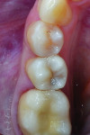 Figure 1 (Case 1) Preoperative view of tooth No. 29. Upon clinical examination, caries on the distoocclusal was noted; a bitewing radiograph
confirmed the need for an interproximal restoration.