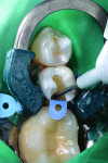 Figure 5 To promote excellent marginal adaptation and sealing at the gingival margin of the proximal box, the first restorative layer was placed using SureFil® SDR® flow Posterior Bulk Fill Flowable Base (DENTSPLY Caulk). This bulk-fill flowable composite provides efficiency due to its self-leveling handling and the ability to place it in 4-mm increments.