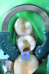 Figure 3 Rubber dam was placed and isolation of the preparation was achieved using the Palodent® Plus Sectional Matrix System (DENTSPLY Caulk), which consists of three parts: an EZ-Coat sectional matrix, a nickel titanium ring, and Wave wedges. As shown, the system provides excellent isolation, and, because the ring facilitates tooth separation, contact creation is simple and predictable.