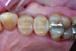 Figure 13 The final restorations on teeth Nos. 4 and 5. Note the excellent contour and interproximal contacts achieved. In the author’s practice, completing multiple composite restorations like this can be very time-consuming when using traditional matrix systems. However, the Palodent® Plus Sectional Matrix combined with the other Class II solution products enables efficiency and uncompromised clinical outcomes.
