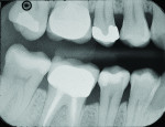 Figure 10 Final radiograph of the disto-occlusal restoration on tooth No. 29 showing excellent contour, marginal adaptation, and radiopacity. Note that the radiopacities of SureFil® SDR® flow material and TPH Spectra® composite were matched to create the appearance of one contiguous restoration without demarcations between material layers.