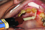 Figure 9 Duo-Link Universal dual-cure luting cement was then placed on prepared surface of the teeth.