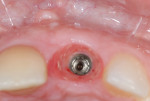 Figure 2 8 weeks post extraction and implant placement and immediate provisionalization (OsseoSpeed™ EV 4.2 Implant, DENTSPLY Implants).