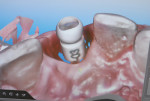 Figure 4 Lingual view of impression component of intraoral scan (iTero®, Align Technology).
