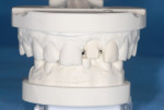 Figure 6 Milled iTero model with removable ATLANTIS Abutment analog in place.