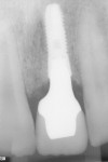Figure 10 Radiograph of final restoration to verify proper seating of all components, including the abutment and crown, and to attain a baseline reading of bone levels to evaluate implant bone maintenance and integration in the future.