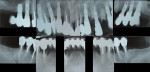 Figure 1 Pre-treatment full-mouth radiographs.