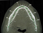 Figure 3 Pre-treatment CBCT, selected occlusal image.