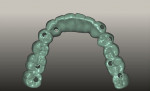Figure 9 Virtual design of mandibular prototype and definitive restoration, occlusal view.