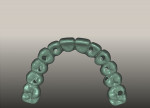 Figure 7 Virtual design of maxillary prototype and definitive restoration, occlusal view.