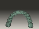 Figure 8 Virtual design of maxillary prototype and definitive restoration, intaglio view.