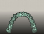 Figure 10 Virtual design of mandibular prototype and definitive restoration, intaglio view.