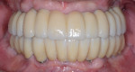 Figure 15 Intraoral frontal view of completed maxillary and mandibular zirconia restorations.