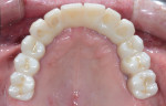 Figure 18 Intraoral occlusal view of maxillary zirconia restoration at 1.5 years.
