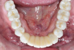 Figure 19 Intraoral occlusal view of mandibular zirconia restoration at 1.5 years.