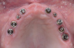 Figure 13 Intraoral occlusal view of maxillary implant abutments.