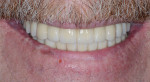 Figure 20 Post-treatment full smile at 1.5 years.