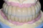 Figure 12 Extraoral frontal view of the
completed maxillary and mandibular articulated zirconia restorations on
master casts.