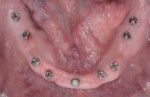 Figure 14 Intraoral occlusal view of mandibular implant abutments.