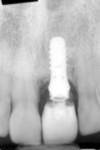 Figure 4 Radiograph of the provisional implant
restoration. Residual excess cement could be noted as well as bone changes developing.