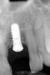 Figure 6 Radiograph from 2009 revealed bone loss most evident at site No. 10 mesial.