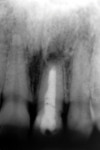 Figure 3 Radiograph from 2005 revealed a complete horizontal fracture and apical radiolucency. The tooth was deemed hopeless
at that time.