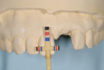 Figure 8 Study cast evaluated for dimensions of teeth using a proportion gauge.