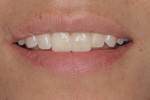 Figure 11 The smile view of the bonded, direct provisional composite bridge.