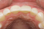 Figure 12 Occlusal view of the bonded, direct provisional composite bridge.