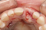 Figure 14 Immediately after the surgery, palatal site used to harvest the free conective tissue graft.
