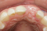 Figure 16 Occlusal view 2 weeks after surgery showed the tissue to be healthy and volumous. The bridge was removed for assesment and was rebonded at the same appointment.