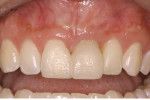 Figure 18 A 3-month postoperative view of the composite bonded bridge. Note healthy appearance.