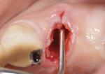 Figure 9 A surgical spoon excavatorwas used to thoroughly debride the extraction socket after sharp dissection of the gingival fibers prior to tooth removal. Note that with the buccal extension of the excavator the labial plate was absent.
