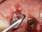 Figure 14 The bone graft was placed between the labial aspect of the implant and palatal to the absorbable collagen membrane.