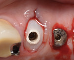 Figure 15 The previously constructed two-piece custom healing abutment was reinserted to contain, protect, and maintain the bone graft material during the healing phase of treatment.
