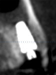 Figure 16 8-month post-surgical–healing CBCT showed radiographic re-establishment of the buccal bone plate prior to first disconnection and impression-making.