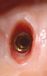 Figure 18 First disconnection of the healing abutment at tooth No. 12 showed anatomic shape of the socket and buccal ridge maintenance.