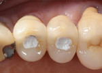 Figure 19 Occlusal–buccal view of the definitive screw-retained implant crowns for teeth Nos. 12 and 13.