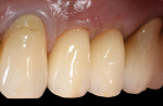 Figure 20 Facial view of the definitive screw-retained implant crowns for teeth Nos. 12 and 13.