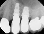 Figure 21 The definitive periapical radiograph of implant restorations Nos. 12 and 13 showing more than adequate bone levels around both implants 10 months after implant surgery.