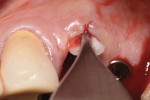 Figure 13 Absorbable collagen membrane was shaped to extend beyond the lateral walls of the defect and subsequently placed into the socket to the level of the FG M. Only the “cone” portion of the “ice cream cone” membrane was used.
