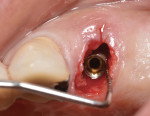 Figure 10 The engagement of the lateral walls of the first bicuspid socket was used for primary stability. Implant was placed with a palatal bias no less than 3 mm and no deeper than 4 mm from the labial FG M to allow greater vertical distance for proper submergence profile of the custom healing abutment.